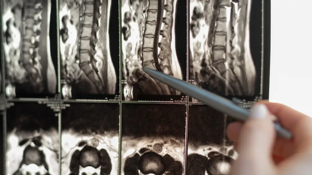 Spinal Cord Injury Scan