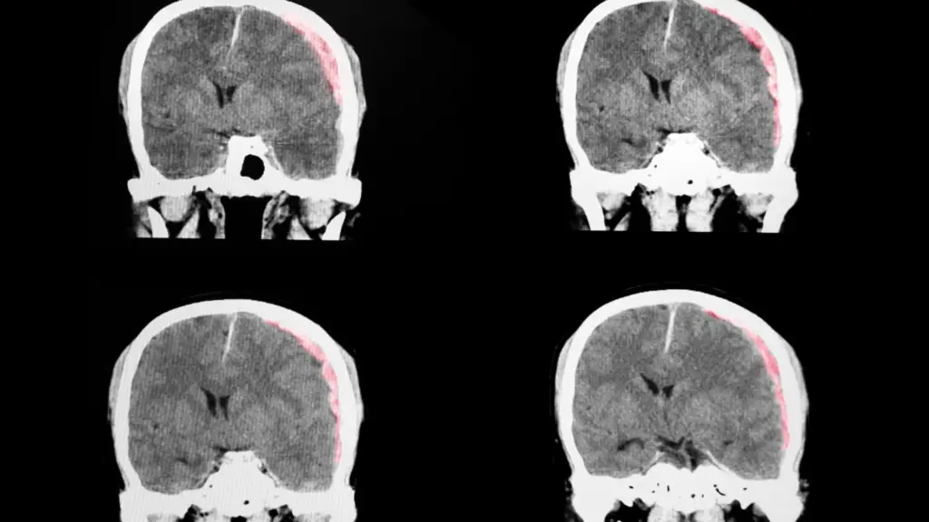 Traumatic Brain Injury Scans